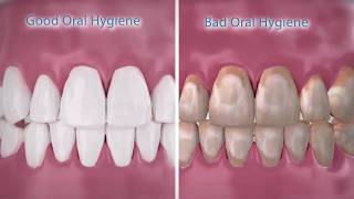 Brushing and Flossing With Braces English