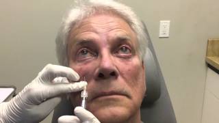 Non-surgical treatment for retracted eyelid | Dr Guy Massry