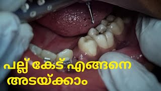 Tooth filling / പല്ല് കേട് അടക്കുന്നത്  at dentist