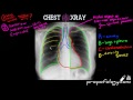 LEARN to Read a Chest Xray in 5 minutes!