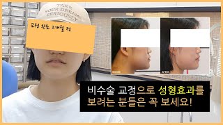 비수술 주걱턱 교정 후기 '수술처럼 성형처럼 안변해요'