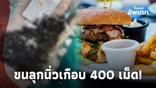 ขนลุก! ผ่านิ่วในถุงน้ำดีเกือบ 400 เม็ด สาเหตุจากของโปรดใกล้ตัว ใครชอบกินระวัง Update-16-JJ