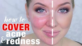 How to Cover Acne \u0026 Redness | DRUGSTORE Makeup