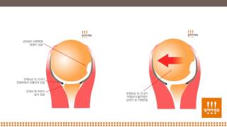 습관성 어깨 탈구 - 일러스트로 설명하기 + 어깨탈골 @달려라병원