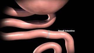 gastric bypass