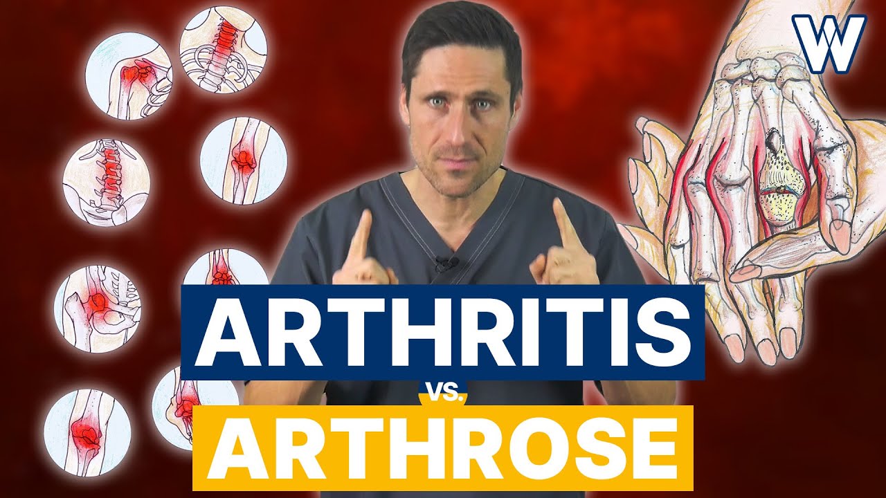 Arthrose Vs. Arthritis: Gibts Unterschiede? Ursachen Und Therapien Von ...