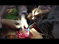 bloodless medicine and surgery liver resection