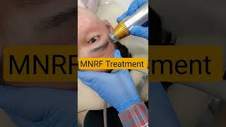 MNRF Treatment for Face Scars