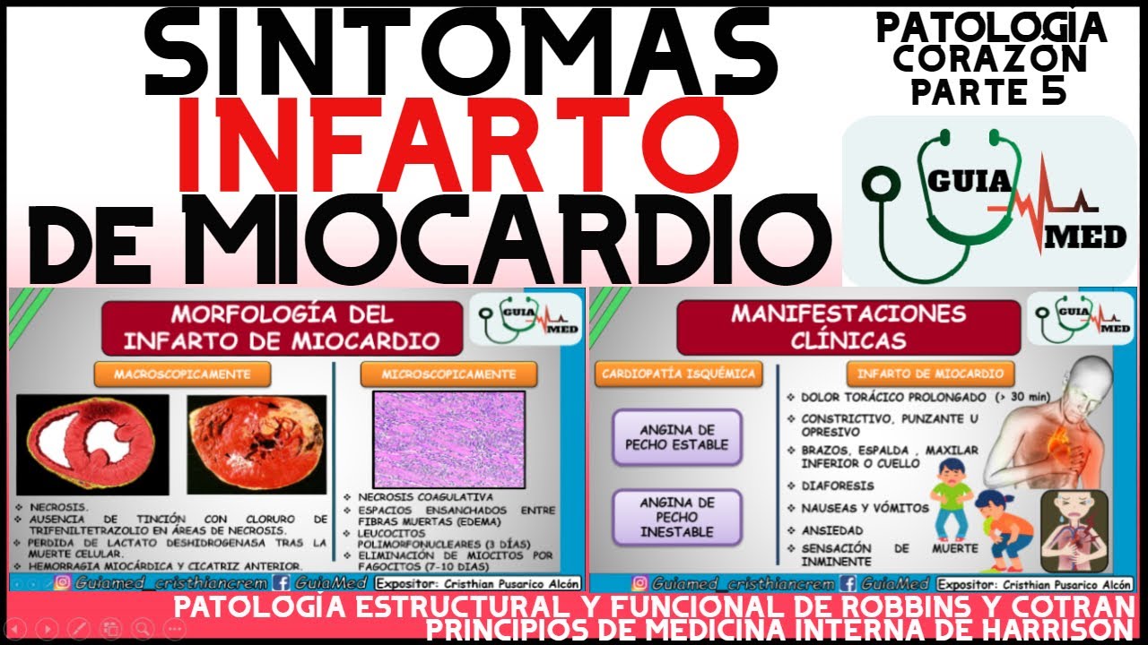 Infarto Agudo Del Miocardio