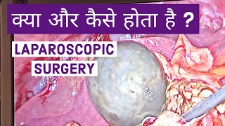 Laparoscopic Operation Surgery - हिंदी में