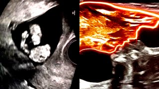 These Are the Strangest Things Seen in Ultrasounds