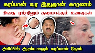 கரப்பனை முற்றிலும் குணமாக்கும் வழிகள்! Dr. Sivaraman speech about Eczema in Tamil | Skin | கரப்பான்