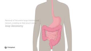 Creation of loop ileostomy by removing large intestine, rectum | Ostomy surgery | Coloplast India