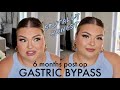 6 MONTHS POST OP GASTRIC BYPASS UPDATE