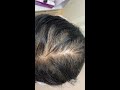 ผมบางศีรษะล้านจากพันธุกรรมในเพศหญิง androgenetic alopecia aga female pattern hair loss