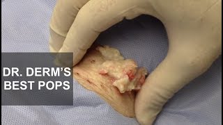 Dr. Derm's Best Pops | Dr. Derm