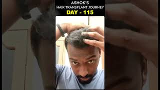 #AskDrJohnWatts | DAY - 115 of ASHOK’S HAIR TRANSPLANT JOURNEY | #besthairtransplant #drjohnwatts