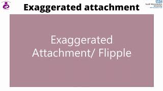 Exaggerated attachment