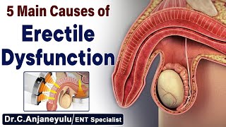 Main Causes of Erectile Dysfunction | Causes Of Impotence | Dr Rahul Reddy | Socialpost Healthcare