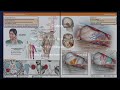 resection of tegmental midbrain cavernous malformation through the lateral sctt approach