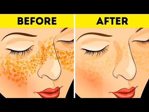 How to Get Rid of Acne Scars and Spots In Just 3 Days How to Get Rid of Acne Scars and Spots In Just 3 Days
