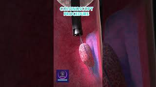 How to Performed Colonoscopy | Endoscopy Procedure |