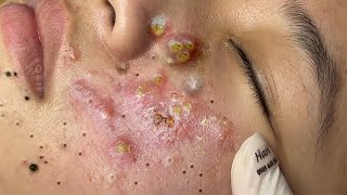 Big Cystic Acne Blackheads Extraction Blackheads \u0026 Milia, Whiteheads Removal Pimple Popping # 1677