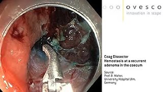 Hemostasis at a recurrent adenoma in coecum | Coag Dissector