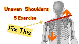 Uneven Shoulders How to Fix ? Exercises to correct Shoulder Level. Shoulder Asymmetry