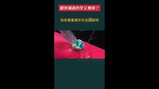 銀汞補過的牙又壞掉了 |蛀牙 |補牙| 牙齒健康 | 牙醫推薦 | 深圳睇牙 | 大灣區睇牙 | 珠海維港口腔 | 維港口腔連鎖