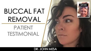 Buccal Fat Removal Before and After | Patient Testimonial