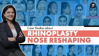 Case Study about Rhinoplasty or Nose Reshaping Surgery in Hindi | Dr. Shilpi Bhadani