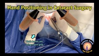 Proper Hand Positioning in Cataract Surgery