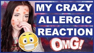 My Crazy Allergic Reaction