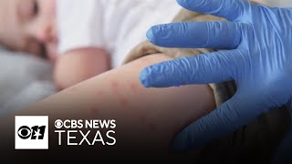 Healthcare providers in North Texas on high alert for measles