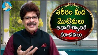 మొండి మొటిమలు ఏ వ్యాధులను సూచిస్తాయి? ఎలా తగ్గుతాయి? Acne suggests underlying disease by Dr. Murali