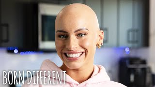 I Watched Myself Go Bald Three Times | BORN DIFFERENT