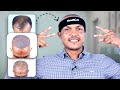 A Look into My Hair Transplant Surgery 😃 | Hair Transplant in Bangladesh | New Roots