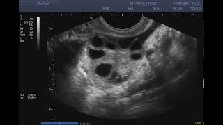 SonoScape E1Exp transvaginal probe Polycystic Ovary