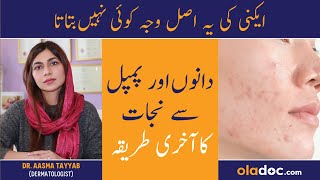 Dane Khatam Karne Ka Tarika - How To Make Acne Disappear - Pimple Kyun Hote Hai - Acne Ka Fori Ilaj