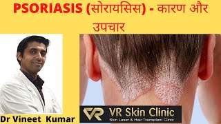 Psoriasis- Causes & Treatment | सोरायसिस - कारण और उपचार | VR Skin Clinic | Bikaner | Rajasthan