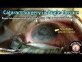 CataractCoach 1549: cataract surgery in angle closure glaucoma