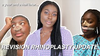 Revision Rhinoplasty Update | 1.5 Years | Dr. Emrah Celik