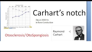 ENT Carhart Notch Audiogram Pure Tune Audiometry Otosclerosis OtoSpongiosis