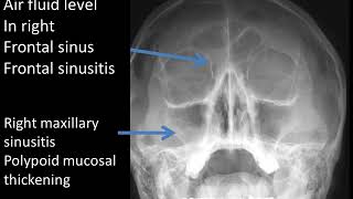 CASE 353 RIGHT FRONTAL MAXILLARY SINUSITIS