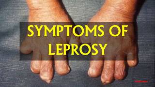 SYMPTOMS OF LEPROSY