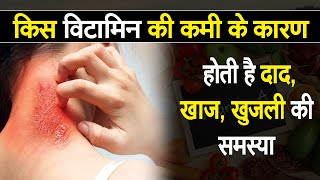 Due to the deficiency of a vitamin, the problem of ringworm, itching, occurs दाद, खाज, खुजली