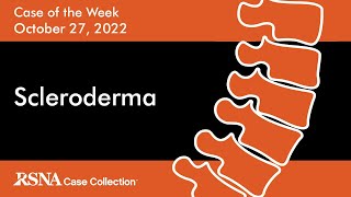 Case of the Week: Scleroderma