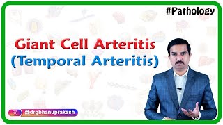 Giant cell arteritis (Temporal arteritis)  Vasculitis Pathology :  Usmle Step 1