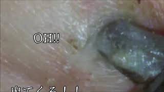 giant blackhead【閲覧注意】膿む前にお父さんのお腹の何かを出す（完結編）